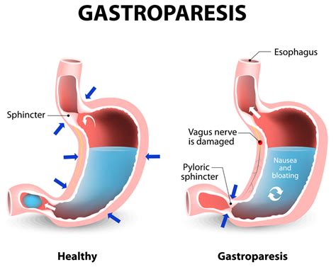 Gastroparesis 中文